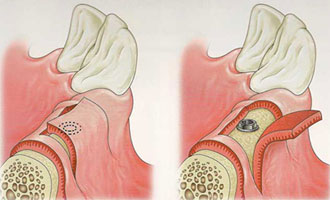 cirugias-encias-clinica-dental-madrid-implantes-1