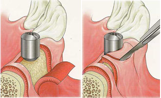 cirugias-encias-clinica-dental-madrid-implantes-2