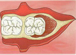 cirugias-encias-clinica-dental-madrid-membrana-1