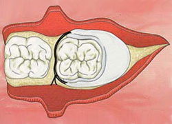 cirugias-encias-clinica-dental-madrid-membrana-3