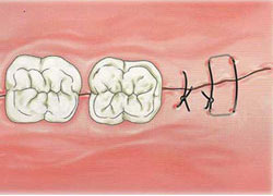 cirugias-encias-clinica-dental-madrid-membrana-4