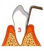 fase-periodontitis-clinica-dental-velazquez-madrid-3