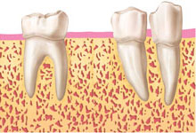 fases-implante-dental-periomadrid-1