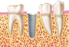 fases-implante-dental-periomadrid-2