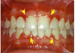 fases-peridontitis-clinica-dental-velazquez-madrid-3