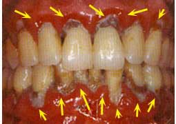 fases-peridontitis-clinica-dental-velazquez-madrid-7