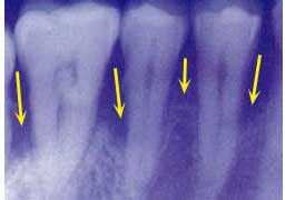 fases-peridontitis-clinica-dental-velazquez-madrid-8
