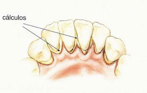 limpieza-placa-dental-gingivitis-periodontitis (1)