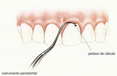 limpieza-placa-dental-gingivitis-periodontitis (2)