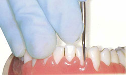 raspado-alisado-radicular-periodontal-madrid (2)