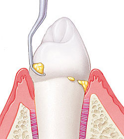 raspado-alisado-radicular-periodontal-madrid