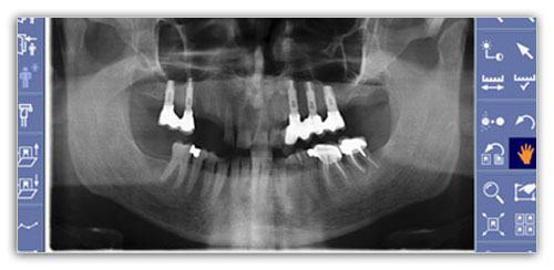 serie-radiografica-periodontitis-madrid (1)