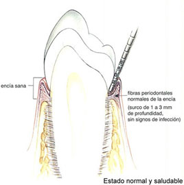 sondaje-etapas-periodontitis-1