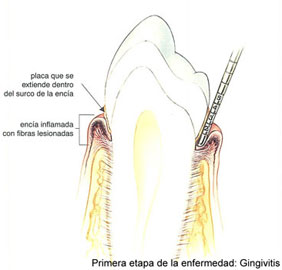 sondaje-etapas-periodontitis-2