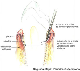 sondaje-etapas-periodontitis-3