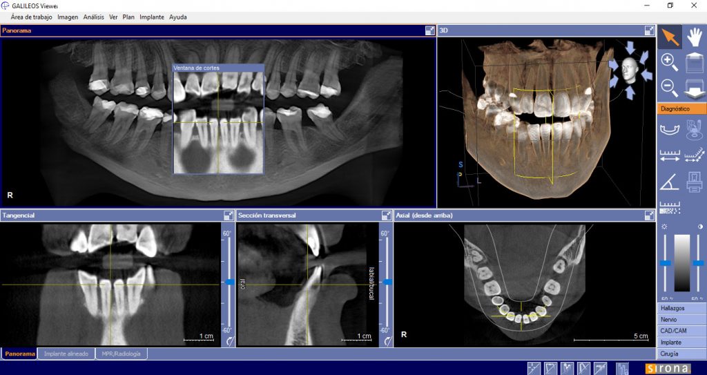 diagnóstico periodontal con radiografia tridimensional