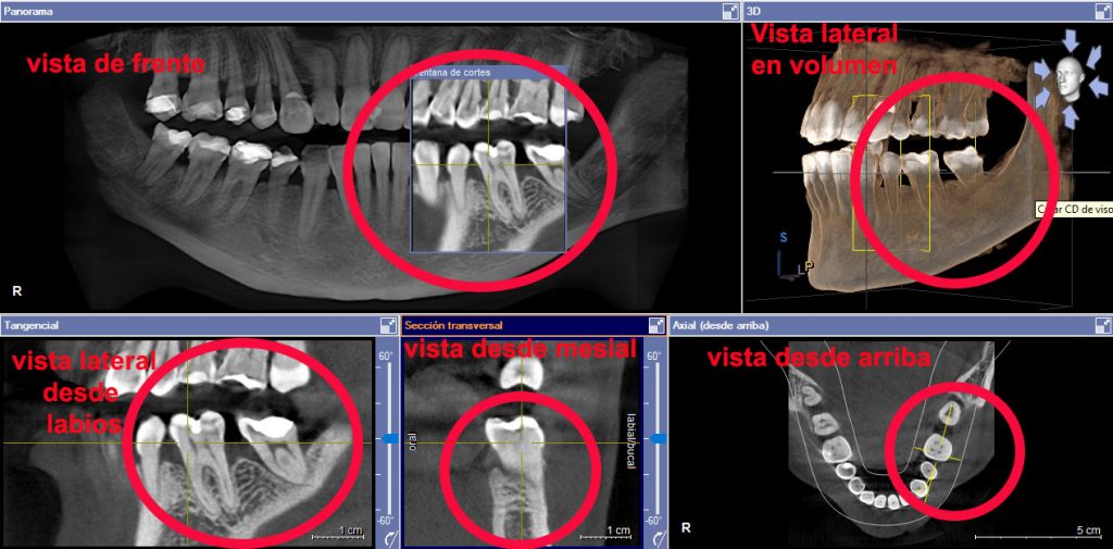radiografia 3D como diagnostico periodontal en Madrid centro